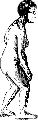 Parinaud Syndrome: figure 2 from the 1928–1936 encyclopedia article