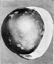 Favus: figure 2 from the 1928–1936 encyclopedia article