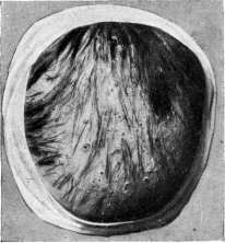 Favus: figure 3 from the 1928–1936 encyclopedia article