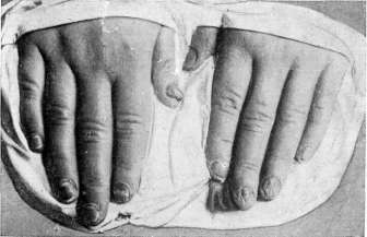 Favus: figure 5 from the 1928–1936 encyclopedia article