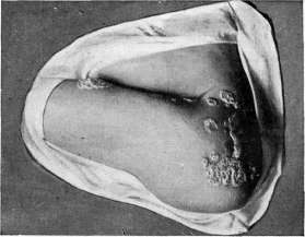 Favus: figure 4 from the 1928–1936 encyclopedia article