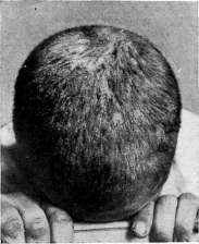Favus: figure 1 from the 1928–1936 encyclopedia article