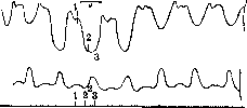 Pericarditis: figure 3 from the 1928–1936 encyclopedia article
