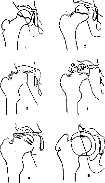 Perthes Disease: figure 1 from the 1928–1936 encyclopedia article