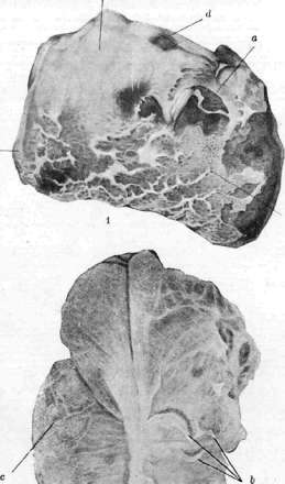 Pleurisy: figure 1 from the 1928–1936 encyclopedia article