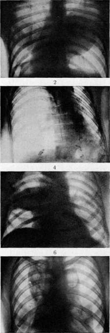 Pleurisy: figure 5 from the 1928–1936 encyclopedia article