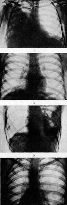 Pleurisy: figure 4 from the 1928–1936 encyclopedia article