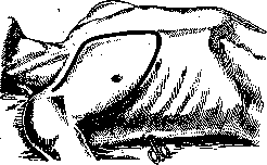 Pleurisy: figure 11 from the 1928–1936 encyclopedia article