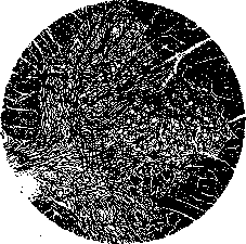POLIOMYELITIS: figure 1 from the 1928–1936 encyclopedia article