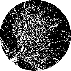 POLIOMYELITIS: figure 2 from the 1928–1936 encyclopedia article