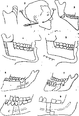 Prognathism (PROGNATHISM, PROGNATHIA, is secondary as a): figure 3 from the 1928–1936 encyclopedia article