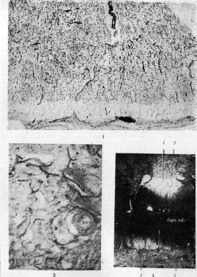 Progressive Paralysis: figure 1 from the 1928–1936 encyclopedia article