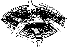 Neurolysis: figure 1 from the 1928–1936 encyclopedia article