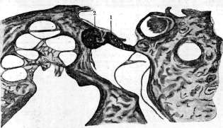 Otosclerosis: figure 2 from the 1928–1936 encyclopedia article