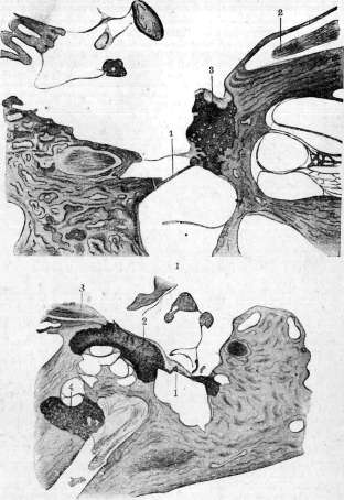 Otosclerosis: figure 1 from the 1928–1936 encyclopedia article