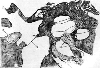Otosclerosis: figure 3 from the 1928–1936 encyclopedia article