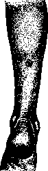 Acalculia: figure 1 from the 1928–1936 encyclopedia article