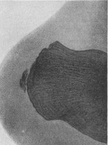 Apostoli Condenser Bed: figure 2 from the 1928–1936 encyclopedia article
