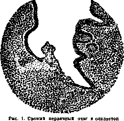 Appendicitis: figure 1 from the 1928–1936 encyclopedia article