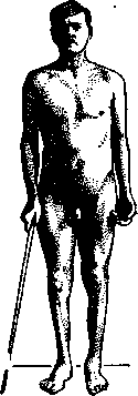 Muscle Atrophy in Diseases of the Nervous System: figure 3 from the 1928–1936 encyclopedia article