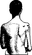 Muscle Atrophy in Diseases of the Nervous System: figure 1 from the 1928–1936 encyclopedia article
