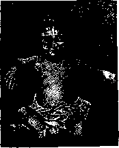 Barlow's Disease: figure 3 from the 1928–1936 encyclopedia article