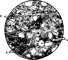 Barlow's Disease: figure 1 from the 1928–1936 encyclopedia article