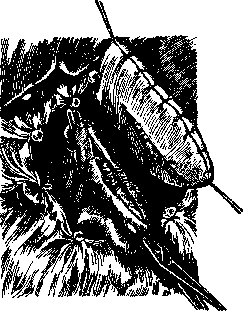 Billroth Operations on the Stomach: figure 7 from the 1928–1936 encyclopedia article