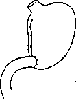 Billroth Operations on the Stomach: figure 1 from the 1928–1936 encyclopedia article