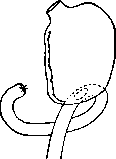 Billroth Operations on the Stomach: figure 4 from the 1928–1936 encyclopedia article