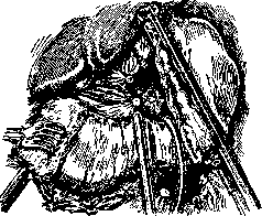 Billroth Operations on the Stomach: figure 2 from the 1928–1936 encyclopedia article