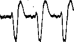 Heart Block: figure 9 from the 1928–1936 encyclopedia article
