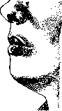 Botryomycosis: figure 1 from the 1928–1936 encyclopedia article