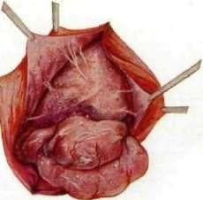Peritoneum: figure 3 from the 1928–1936 encyclopedia article