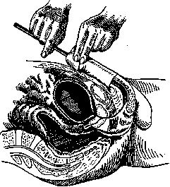 Bougienage: figure 1 from the 1928–1936 encyclopedia article