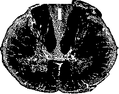 Wallenberg Syndrome and Waller's Degeneration: figure 2 from the 1928–1936 encyclopedia article