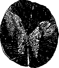 Wallenberg Syndrome and Waller's Degeneration: figure 3 from the 1928–1936 encyclopedia article