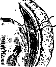 Ventrofixation: figure 1 from the 1928–1936 encyclopedia article