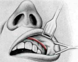 Maxillary Sinusitis: figure 1 from the 1928–1936 encyclopedia article
