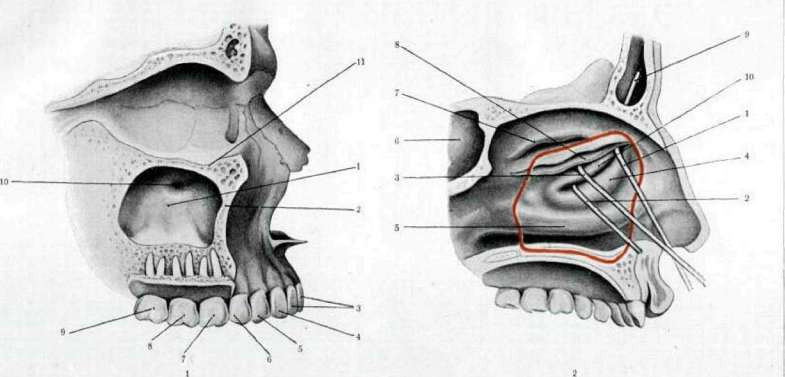 Maxillary Sinusitis: figure 3 from the 1928–1936 encyclopedia article