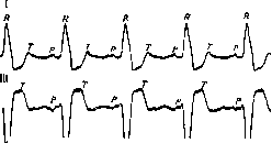 Gallop Rhythm: figure 1 from the 1928–1936 encyclopedia article