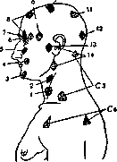 Head's Zones: figure 2 from the 1928–1936 encyclopedia article