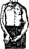 Heine-Medin Disease: figure 3 from the 1928–1936 encyclopedia article