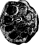 Hydronephrosis: figure 3 from the 1928–1936 encyclopedia article