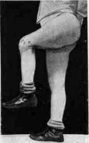 Hyrtl: figure 6 from the 1928–1936 encyclopedia article