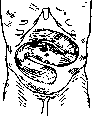 Hirschsprung Disease: figure 6 from the 1928–1936 encyclopedia article