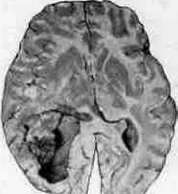 Brain (551 General diagnostics of brain diseases): figure 40 from the 1928–1936 encyclopedia article