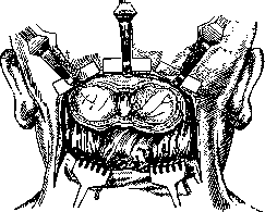 Brain (551 General diagnostics of brain diseases): figure 53 from the 1928–1936 encyclopedia article