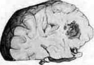 Brain (551 General diagnostics of brain diseases): figure 39 from the 1928–1936 encyclopedia article