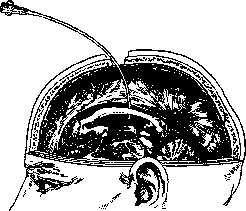 Brain (551 General diagnostics of brain diseases): figure 50 from the 1928–1936 encyclopedia article